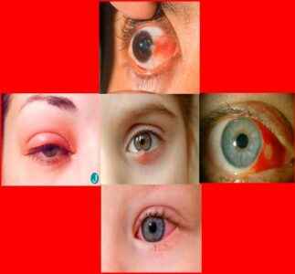 
	پاورپوینت بيماريهاي چشم
