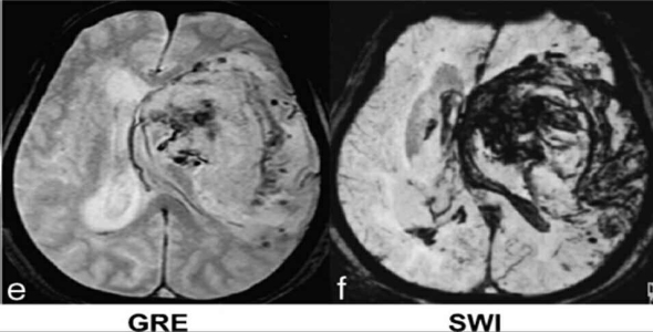 
	پاورپوینت ارزیابی خون ریزی های مغزی در MRI
