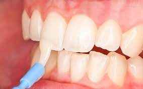 
	پاورپوینت فلوراید و وارنیش فلوراید
