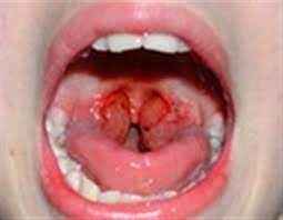 
	پاورپوینت مراقبت بيماري سياه سرفه و ديفتري
