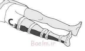 
	پاورپوینت شکستگی وآتل بندی
