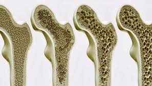 
	تحقیق پوکي استخوان چيست؟
