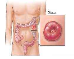 
	پاورپوینت جراحی استومی
