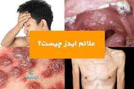 
	پاورپوینت ایدز و درمان آن
