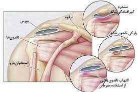 
	پاورپوینت آسیب های شانه
