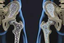 
	تحقیق پوكي استخوان
