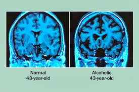 
	پاورپوینت اثرات الکل برمغز
