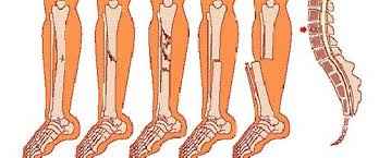 
	تحقیق دير جوش خوردن و جوش نخوردن دو سر استخوان شكسته یا بدجوش خوردن قطعات استخوان شكسته
