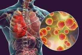 
	پاورپوینت درمان ضد میکروبی خارج از بیمار در پنومونی حاد اکتسابی جامعه
