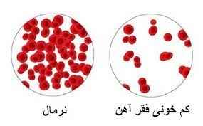 
	پاورپوینت کم خونی ناشی از فقر آهن
