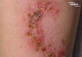 
	پاورپوینت لیشمانیازیس مشترک بین انسان و حیوان
