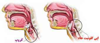 
	پاورپوینت کروپ و اپی گلوتیت
