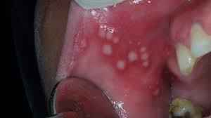 
	پاورپوینت بيماري بهجت (سندرم بهجت)
