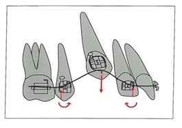 
	بررسی  نیروها در وایر و براکت های ارتودنسی
