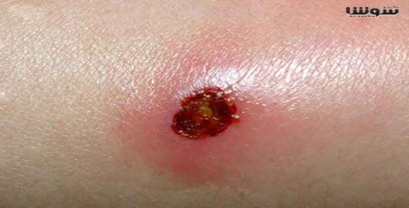 
	پاورپوینت عفونت های استافیلوکوکی
