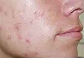 
	پاورپوینت شایعترین بیماری پوست و موی جوانان (جوش)
