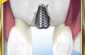 
	تحقیق بررسي عوامل مؤثر در موفقيت ايمپلنتهاي Osseointegrated
