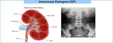 
	پاورپوینت IVP (Intravenous Pyelography)
