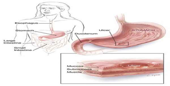     پاورپوینت بررسی زخم معده و اثنی عشر - فروشگاه فایل
