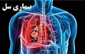 
	تحقیق بیماری سل
