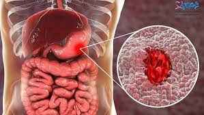 
	پاورپوینت زخم معده
