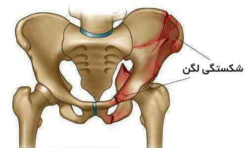 
	پاورپوینت شکستگی لگن
