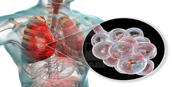 
	پاورپوینت پنوموني
