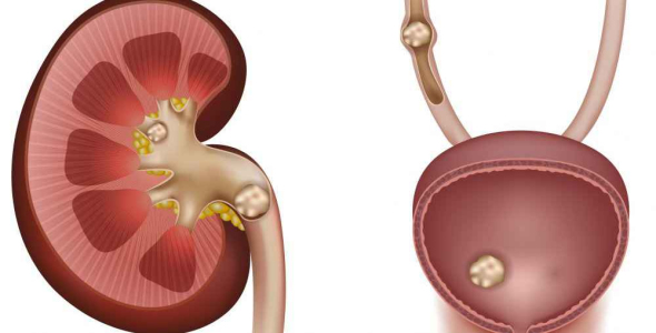 
	پاورپوینت سنگ های دستگاه ادراری
