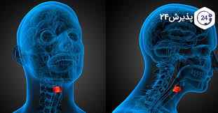 
	تحقیق سرطان حنجره
