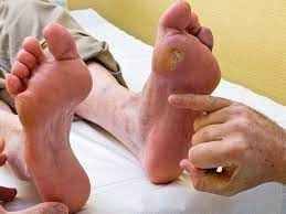 
	تحقیق زخم پای دیابتی چیست؟
