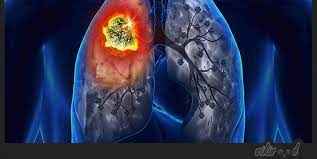 
	تحقیق التهاب ریوی
