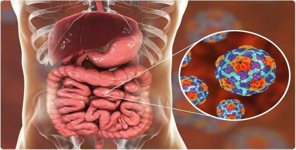 
	پاورپوینت گاستروآنتريت
