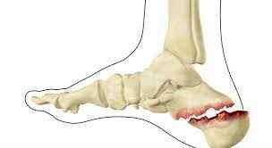 
	پاورپوینت شکستگی
