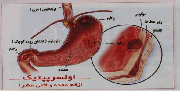     پاورپوینت زخم معده - فروشگاه فایل
