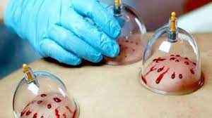 
	پاورپوینت تاثیرات حجامت
