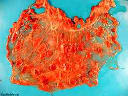 
	باکتری کوکسیلا بورنتی
