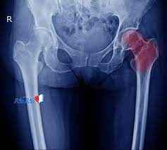 
	پاورپوینت PELVIC FRACTURE شکستگی لگن
