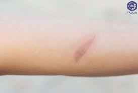 
	تحقیق اطلاعات سوختگی
