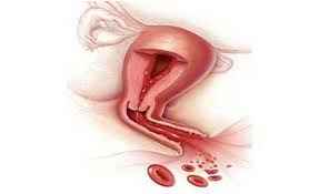 
	پاورپوینت خونریزی های غیر طبیعی در قبل و پس از یائسگی
